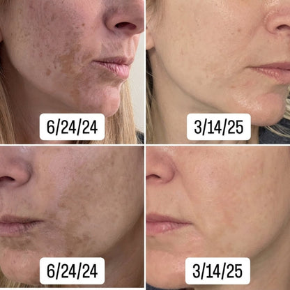 Dark Spot Brightening Gel