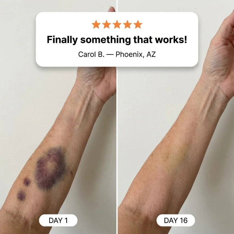 Bruise Recovery Cream – Arnica & Vitamin K